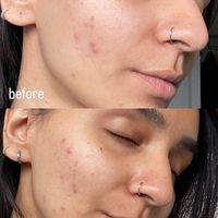 Before and after comparison photos showing facial skin improvement, with clearer complexion in the after image