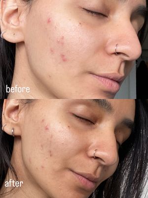 Before and after comparison photos showing facial skin improvement, with clearer complexion in the after image