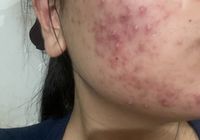 Person showing facial skin condition with reddish patches on cheek area
