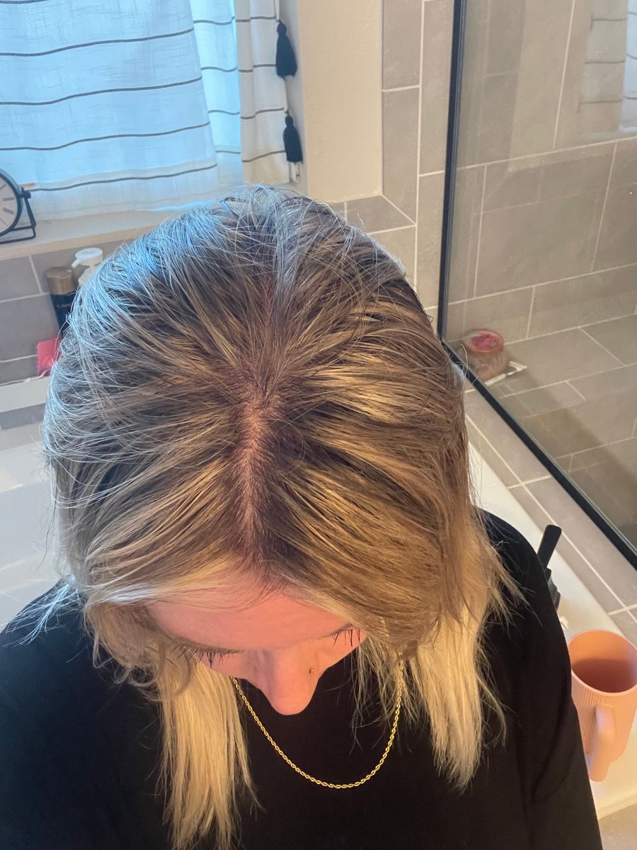 Before and after of Sara showing hairline growth