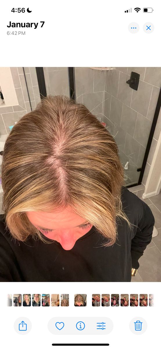 Before and after of Sara showing hairline growth