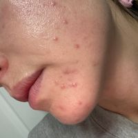 Person with facial skin condition showing redness and irritation
