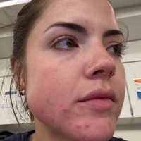 A person with facial bruising and swelling, likely from an injury, in what appears to be a medical or clinical setting